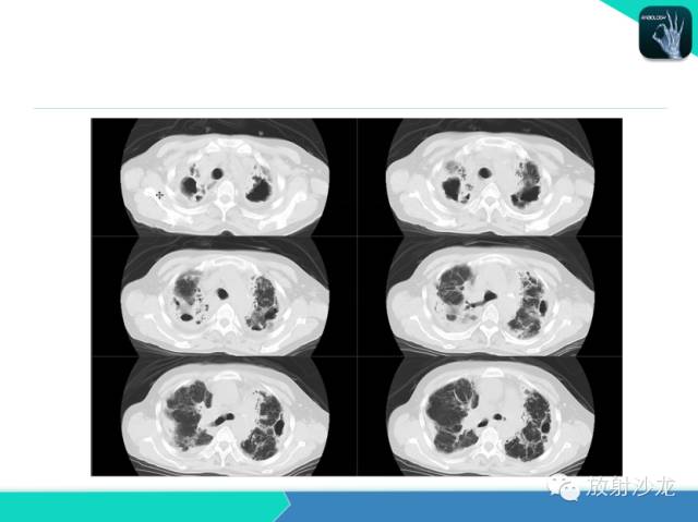 【PPT】肺结核影像学诊断