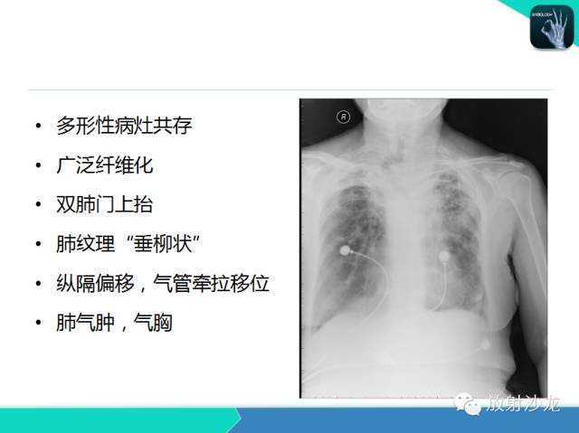 【PPT】肺结核影像学诊断