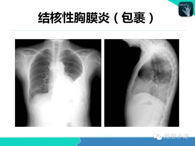 【PPT】肺结核影像学诊断