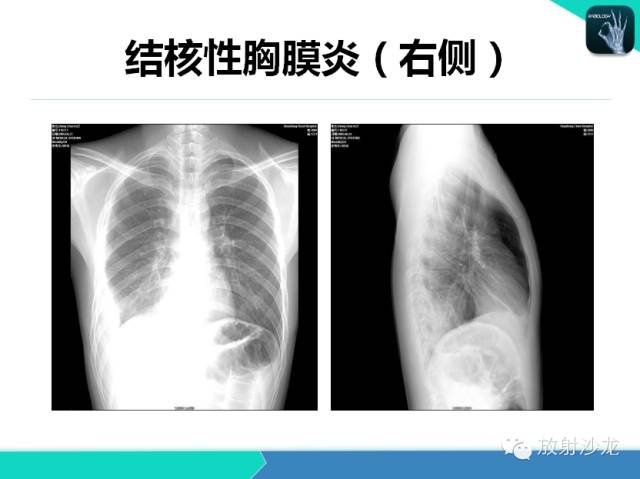 【PPT】肺结核影像学诊断