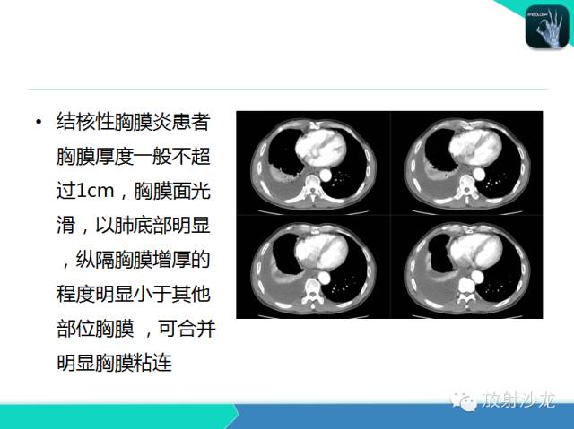 【PPT】肺结核影像学诊断