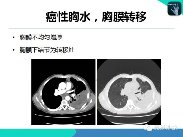 【PPT】肺结核影像学诊断