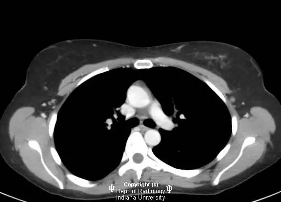 【病例】乳腺浸润性导管癌1例X线影像表现
