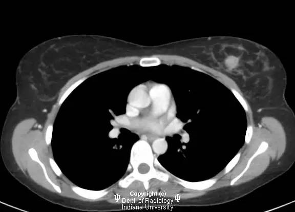 【病例】乳腺浸润性导管癌1例X线影像表现