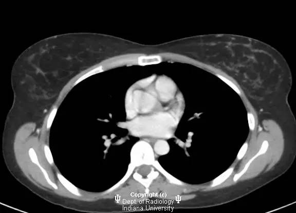 【病例】乳腺浸润性导管癌1例X线影像表现