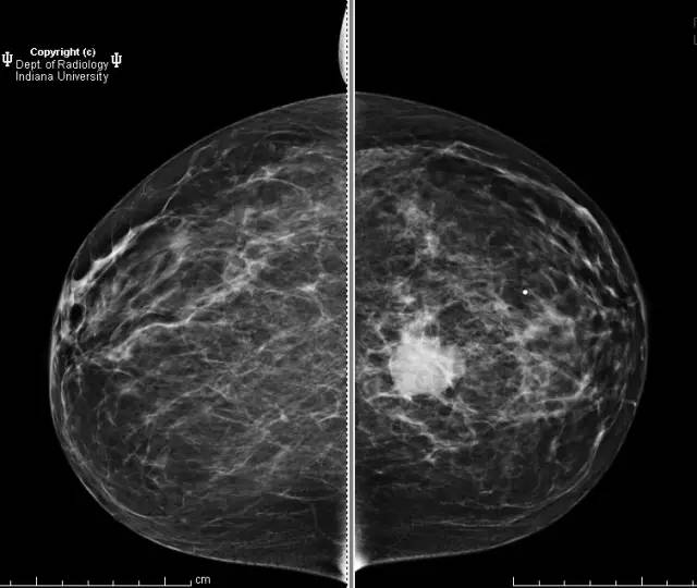 【病例】乳腺浸润性导管癌1例X线影像表现