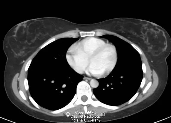 【病例】乳腺浸润性导管癌1例X线影像表现