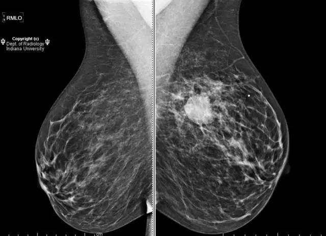 【病例】乳腺浸润性导管癌1例X线影像表现