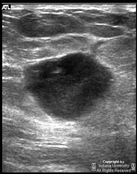 【病例】乳腺浸润性导管癌1例X线影像表现