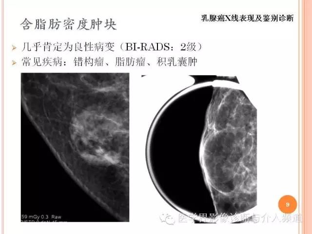 【PPT】乳腺癌的X线表现及鉴别诊断