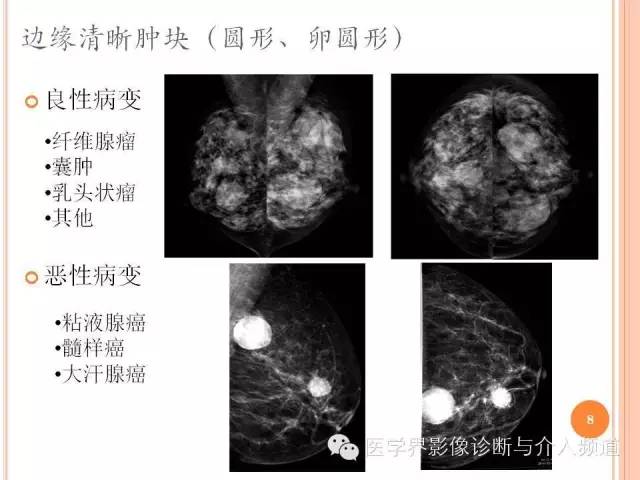 【PPT】乳腺癌的X线表现及鉴别诊断