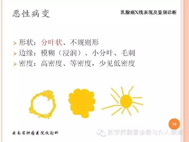 【PPT】乳腺癌的X线表现及鉴别诊断