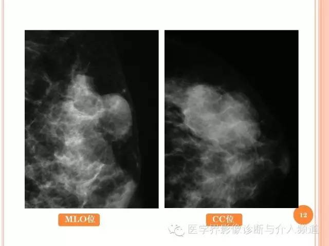 【PPT】乳腺癌的X线表现及鉴别诊断