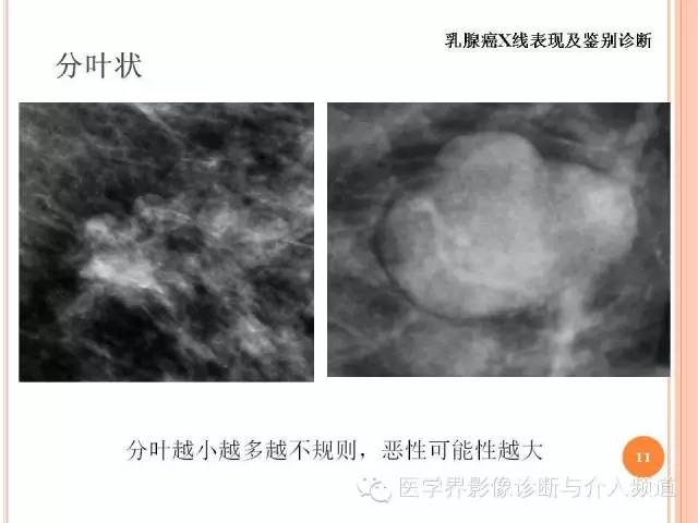 【PPT】乳腺癌的X线表现及鉴别诊断
