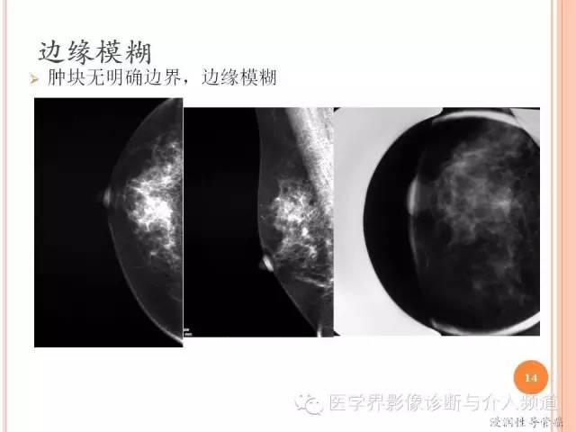 【PPT】乳腺癌的X线表现及鉴别诊断