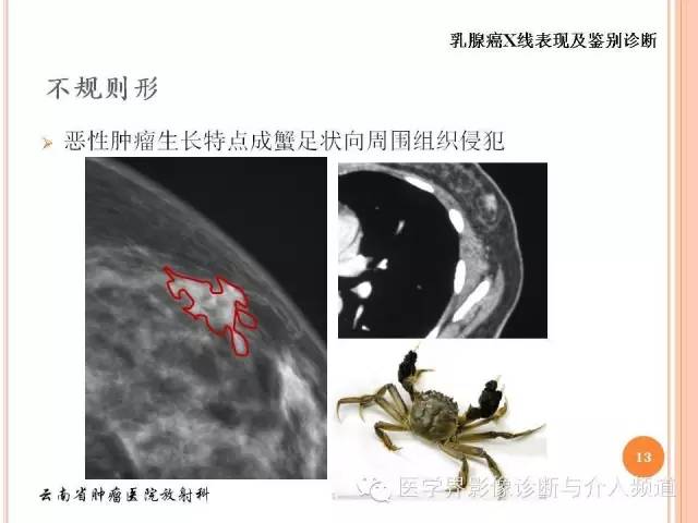 【PPT】乳腺癌的X线表现及鉴别诊断