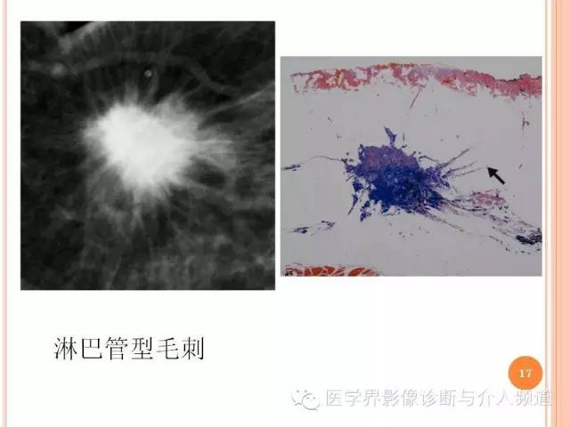 【PPT】乳腺癌的X线表现及鉴别诊断