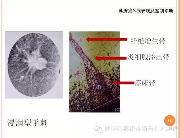 【PPT】乳腺癌的X线表现及鉴别诊断