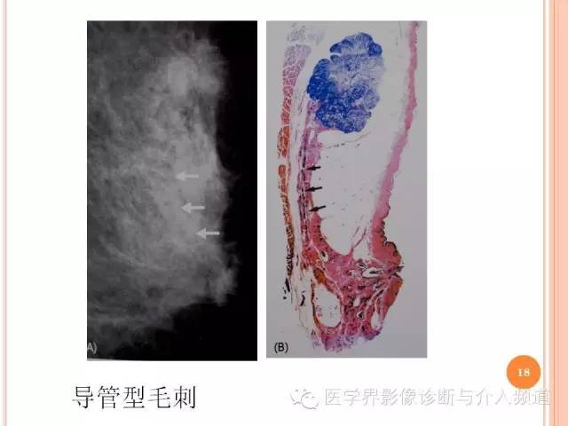 【PPT】乳腺癌的X线表现及鉴别诊断
