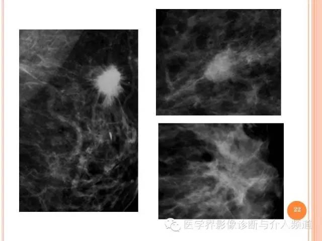 【PPT】乳腺癌的X线表现及鉴别诊断