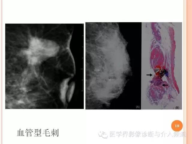 【PPT】乳腺癌的X线表现及鉴别诊断