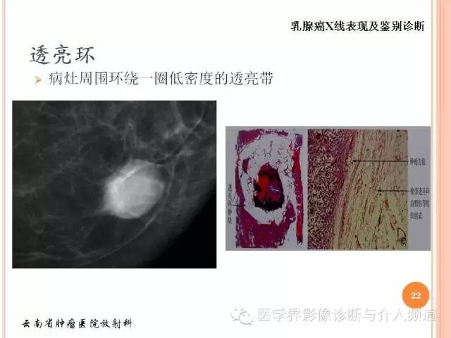 【PPT】乳腺癌的X线表现及鉴别诊断