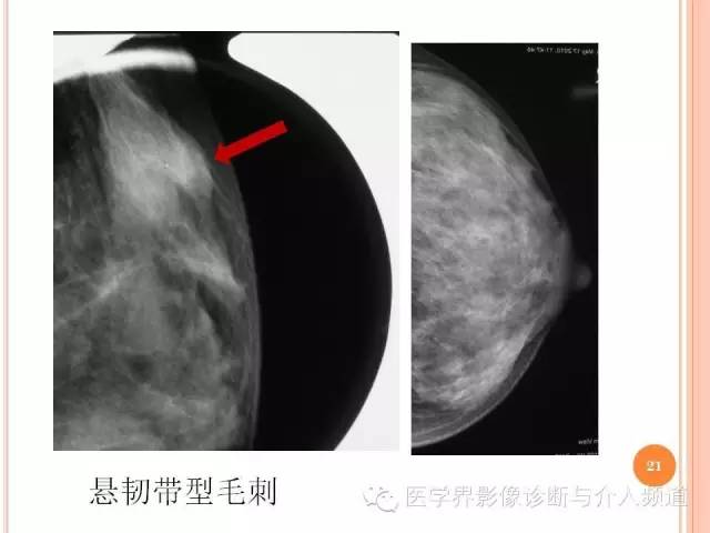 【PPT】乳腺癌的X线表现及鉴别诊断