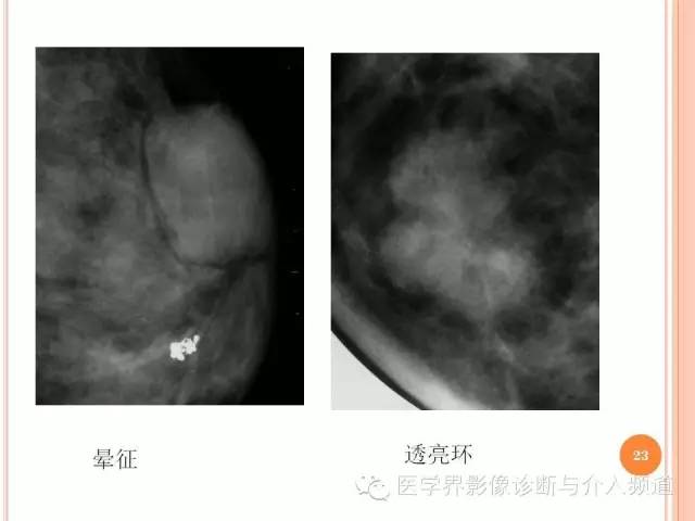 【PPT】乳腺癌的X线表现及鉴别诊断