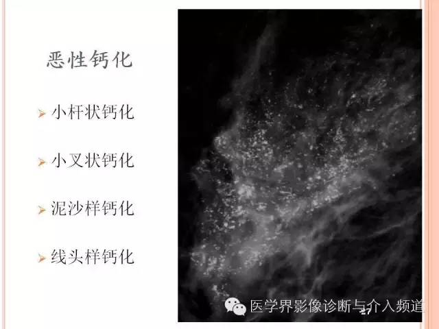 【PPT】乳腺癌的X线表现及鉴别诊断