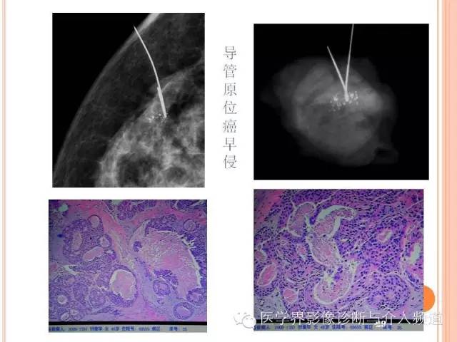 【PPT】乳腺癌的X线表现及鉴别诊断