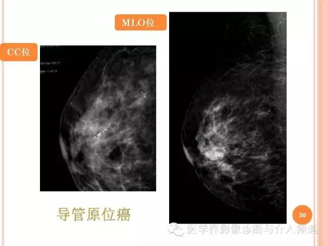 【PPT】乳腺癌的X线表现及鉴别诊断