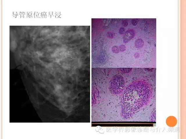 【PPT】乳腺癌的X线表现及鉴别诊断