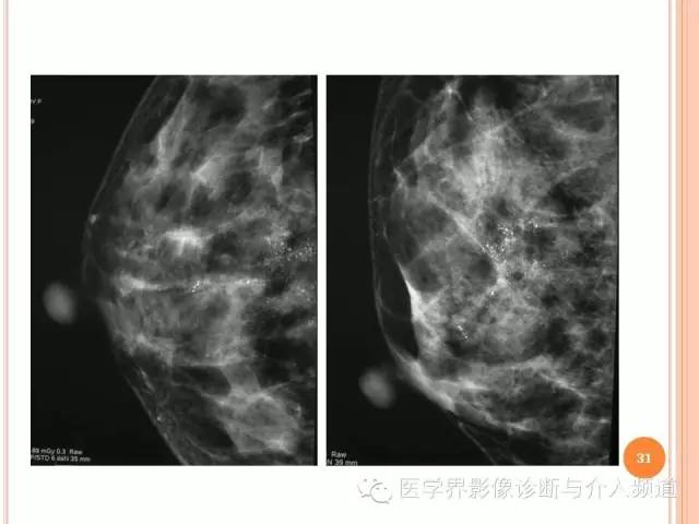 【PPT】乳腺癌的X线表现及鉴别诊断