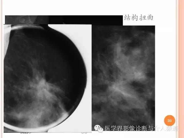 【PPT】乳腺癌的X线表现及鉴别诊断