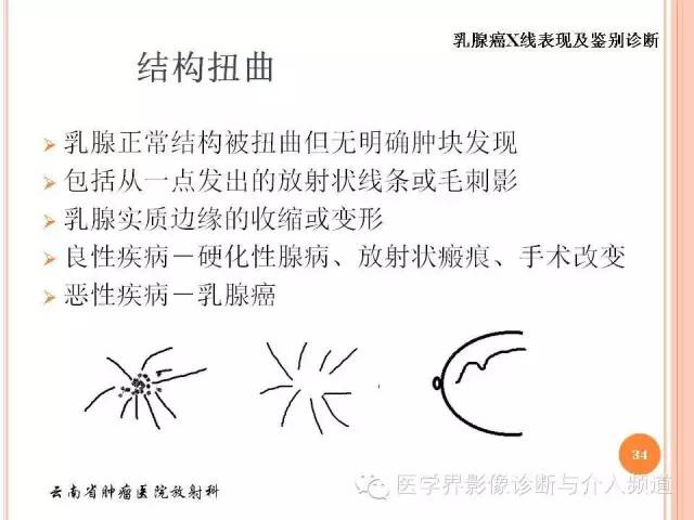 【PPT】乳腺癌的X线表现及鉴别诊断