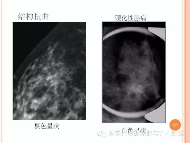 【PPT】乳腺癌的X线表现及鉴别诊断