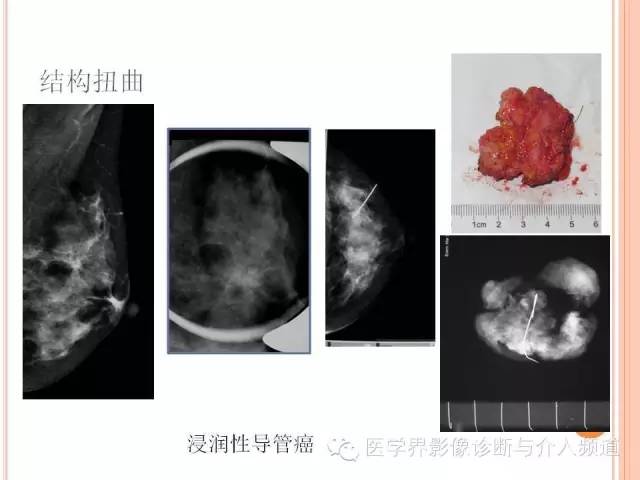 【PPT】乳腺癌的X线表现及鉴别诊断