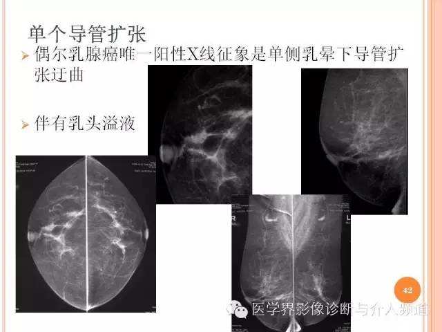 【PPT】乳腺癌的X线表现及鉴别诊断