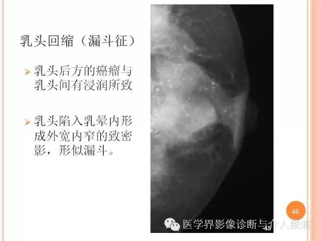 【PPT】乳腺癌的X线表现及鉴别诊断