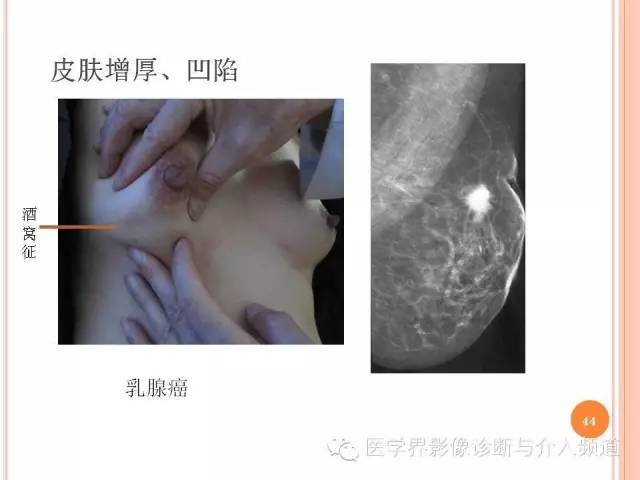 【PPT】乳腺癌的X线表现及鉴别诊断