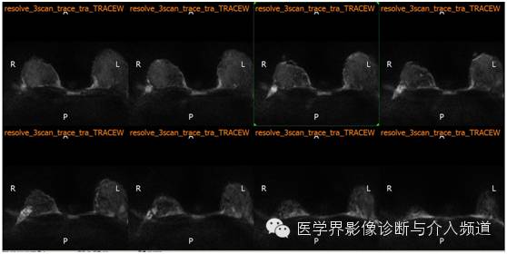 【病例】乳腺癌1例MR影像表现 【病例】乳腺癌1例MR影像表现