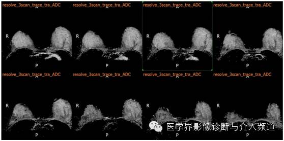 【病例】乳腺癌1例MR影像表现 【病例】乳腺癌1例MR影像表现