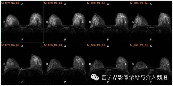 【病例】乳腺癌1例MR影像表现 【病例】乳腺癌1例MR影像表现
