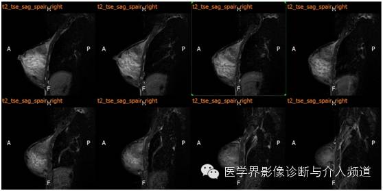【病例】乳腺癌1例MR影像表现 【病例】乳腺癌1例MR影像表现