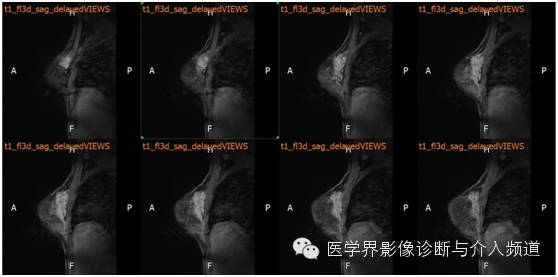 【病例】乳腺癌1例MR影像表现 【病例】乳腺癌1例MR影像表现