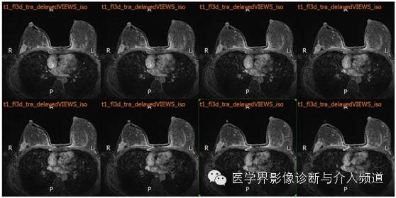 【病例】乳腺癌1例MR影像表现 【病例】乳腺癌1例MR影像表现