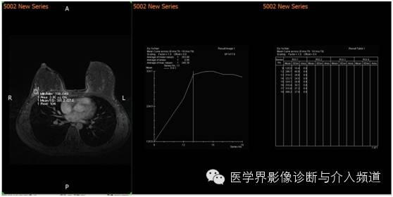 【病例】乳腺癌1例MR影像表现 【病例】乳腺癌1例MR影像表现