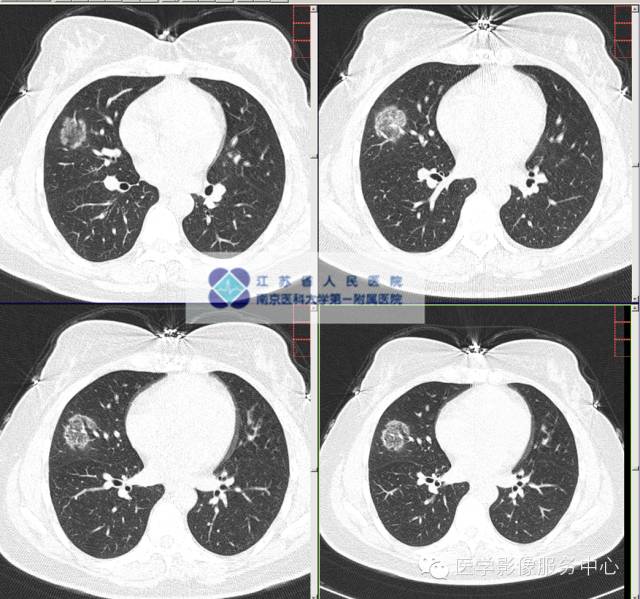 【病例】肺隐球菌病1例CT影像表现 【病例】肺隐球菌病1例CT影像表现