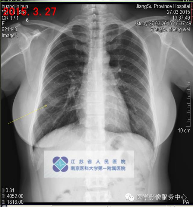 【病例】肺隐球菌病1例CT影像表现 【病例】肺隐球菌病1例CT影像表现