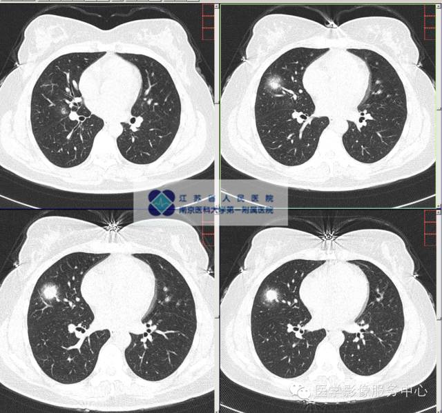 【病例】肺隐球菌病1例CT影像表现 【病例】肺隐球菌病1例CT影像表现